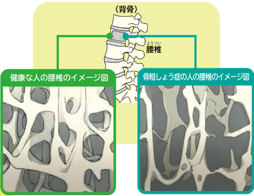 骨粗鬆症